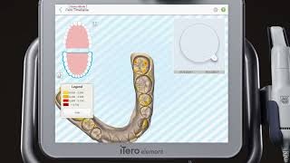 iTero® Scanner Tutorial Using Demo Mode [upl. by Marba551]