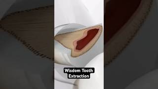 Wisdom Tooth Extraction 3D Animation [upl. by Etteyniv984]