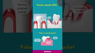 Gingival recession Pocket and clinical attachment loss [upl. by Urban]