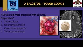 POPCORN CALCIFICATION BRAIN  CAVERNOMACAVERNOUS ANGIOMA [upl. by Farver]