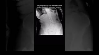 Spine movement seen for the FIRSTTIME with dynamic XRay backpain anatomy [upl. by Mills959]