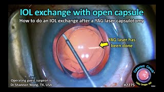 CataractCoach™ 2275 IOL exchange with an open posterior capsule [upl. by Eart772]