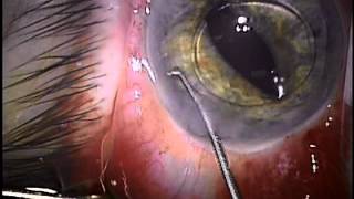 Posterior Chamber Irissutured Intraocular Lens Technique  Marjan Farid [upl. by Nylleoj]