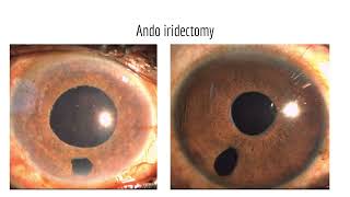 TThe many faces of secondary angleclosure glaucoma A practical approach to unveil [upl. by Lashoh896]