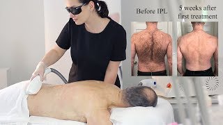 Treating Unwanted Male Body Hair With IPL Grahams Experience [upl. by Ariaes365]