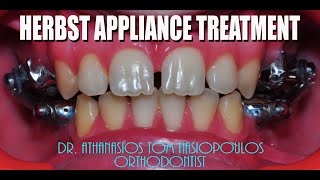 Herbst appliance treatment Case PL  Athanasios Ton Nasiopoulos Orthodontist [upl. by Dacey]