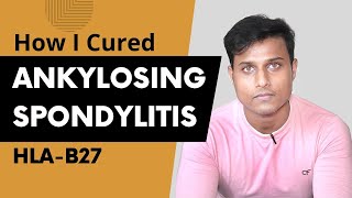 How I Cured My Ankylosing Spondylitis  Ayurvedic Treatment [upl. by Annehsat613]