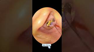 Earwax Removal Part 79 [upl. by Nal]