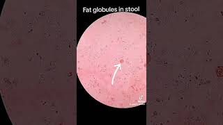 Fat globules in stool [upl. by Lemmy]