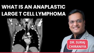 What is Anaplastic Large T Cell Lymphoma  Sign amp Symptoms Treatment Options by Dr Suraj Chiraniya [upl. by Neeven]