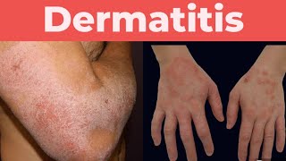 What is Dermatitis A complete guide about Dermatitis [upl. by Quentin]