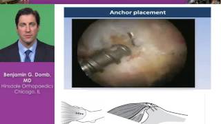 Gluteus Medius Tears Techniques and Indications [upl. by Ylatan]