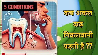 5 Conditions of wisdom tooth removalकब अकल दाढ़ निकलवाना पड़ेगा [upl. by Locklin]