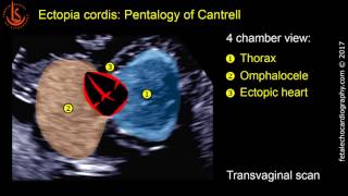 Fetal echocardiography at 1113 weeks Ectopia Cordis in Pentalogy of Cantrell [upl. by Eillom]