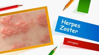 Herpes Zoster [upl. by Zetrauq]