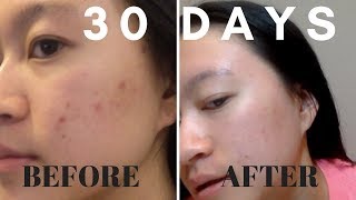 30 DAYS Aztec Secret Healing Clay Mask RESULTS [upl. by Jelena]