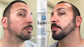 How to grow a REAL Beard  Minoxidil 4 Month Beard Journey [upl. by Julian]