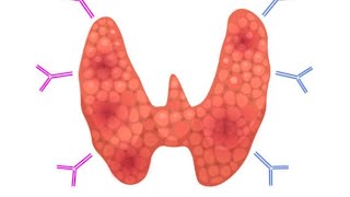 Endocrine Pathology 6 Major Thyroiditis de Quervain Subacute LymphocyticRiedal Thyroiditis [upl. by Everara]