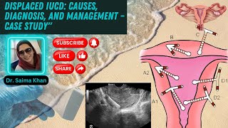 Displaced IUCD Causes Diagnosis and Management – Case Study healthytips DrSaimakhan [upl. by Jelks]