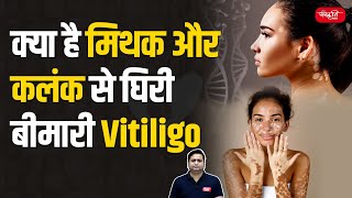 Vitiligo Skin Disease  Myths Stigma and Facts About This Skin Condition  UPSC [upl. by Esinert]