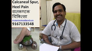 Calcaneal spur treatment  Planter fasciitis  पाष्णीशुल  वातकण्टक  अग्निकर्म  Heel pain [upl. by Runck135]