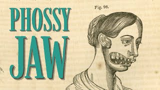 Phossy jaw was utterly horrific  Brief Histories [upl. by Erlene]