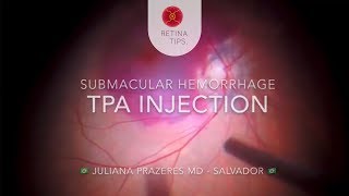 Subretinal injection of tPA in submacular hemorrhage [upl. by Kowtko]