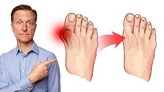 Bunion Pain Relief Tips WITHOUT Surgery  Easy Tips from a Podiatrist [upl. by Atsahs]