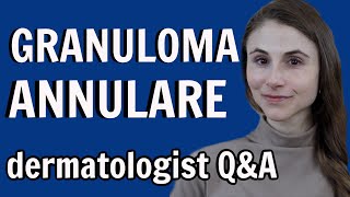 Granuloma annulare treatments and causes dermatologist Dr Dray [upl. by Ifar]