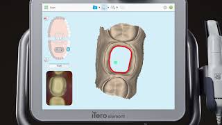 iTero® Scanner Tutorial Using the Eraser Tool [upl. by Trumaine]