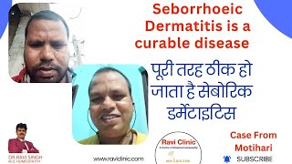 Seborrhoeic Dermatitis Got cured 100  in Online Patient with Homeopathy [upl. by Liba]