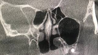 Deviated Nasal Septum explained with Cone Beam CT scan [upl. by Gala583]