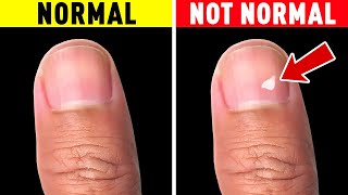 The Truth About White Spots on Your Nails [upl. by Yobybab103]