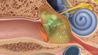 Ruptured eardrum perforated eardrumTreatment for eardrum rupture [upl. by Shaper]