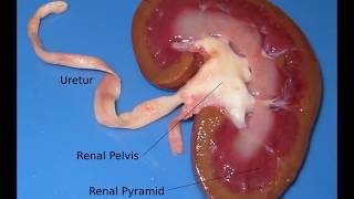 coagulative necrosis kidney gross and microscopic features for medical students [upl. by Leitnahs]