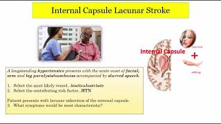 12DaysinMarch Stroke Localization Lacunar Infarcts Part 2 of 3 for the USMLE Step One Exam [upl. by Odrawde356]