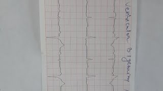 ventricular bigeminy and trigeminy [upl. by Sherrill]