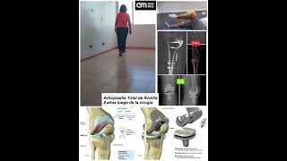 Protesis Total de Rodilla Dr Maizo [upl. by Hoo]