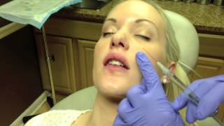 Botox amp Juvederm Lip Injection in Virginia by Dr Naderi DC VA MD [upl. by Adnalahs]