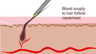 Electrolysis for hair removal [upl. by Nasus]