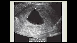 Ultrasound diagnosis of non viable early pregnancy [upl. by Budge173]