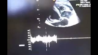 Echo cardiography of cardiac tamponade [upl. by Nnyleitak5]