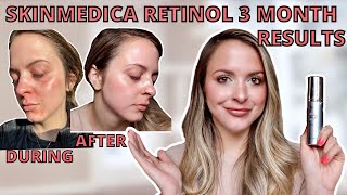 SKINMEDICA RETINOL HONEST REVIEW amp 3 MONTH RESULTS Is Medical Grade Skincare Worth It [upl. by Trescha]