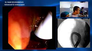 ercp for sems obstruction [upl. by Weinstock]