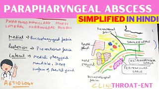 Parapharyngeal Abscess  Hindi  ENT [upl. by Cary]