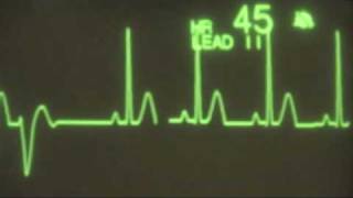 Sinus Rhythm with PVCs  ECG Training [upl. by Oirram]