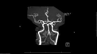 MRA magnetic resonance angiogram head radiology search pattern [upl. by Hcardahs515]