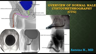 Normal male cystourethrography [upl. by Ahsatan]