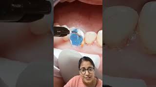 Grossly decayed tooth inbuilt by post and core  shortsfeed youtubeshorts AS dental care viral [upl. by Knight]