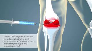 TLC599 Intraarticular Injection for Osteoarthritis Pain [upl. by Elamor311]